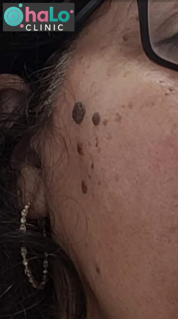 הסרת סבוריאה קרטוזיס