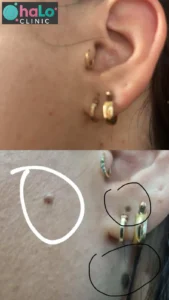 לפני ואחרי הסרת נקודת חן בלייזר – תוצאה אמיתית מלקוחה ב-Halo Clinic