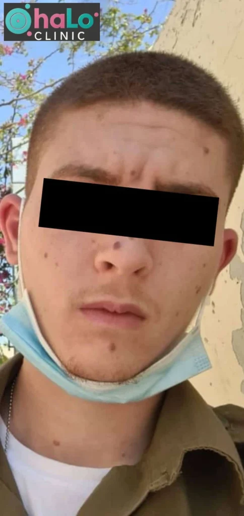 לפני הסרת נקודות חן חשודה