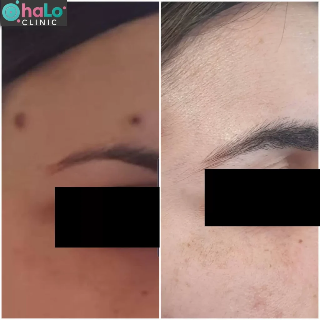 לפני ואחרי הסרת נקודת חן בפנים באמצעות לייזר – תמונה אמיתית של לקוחה לאחר החלמה