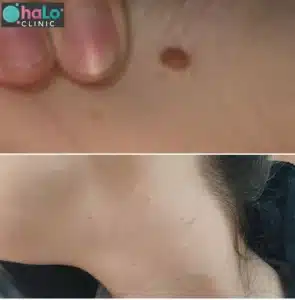 תמונת לפני ואחרי של הסרת שומה בצוואר ב-Halo Clinic