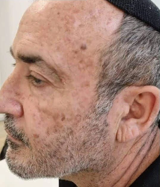 תמונת פנים לפני הסרת כתמי פיגמנטציה וטשטוש נמשים אצל גבר מבוגר