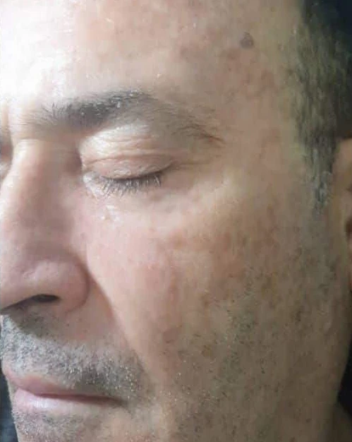 תמונת פנים לאחר הסרת כתמי פיגמנטציה וטשטוש נמשים בטיפול לייזר
