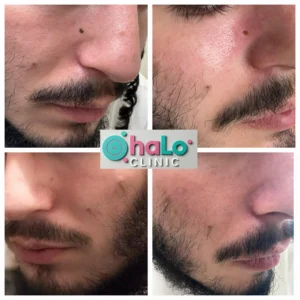 לפני ואחרי טיפול הסרת נקודת חן אמיתי בקליניקה