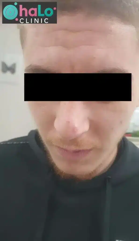 תוצאה לאחר טיפול לייזר להסרת נקודות חן בפנים – Halo Clinic