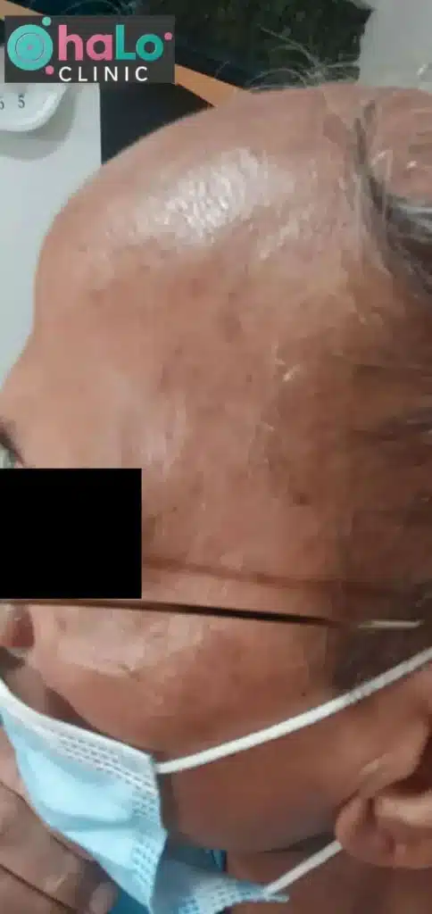 צילום "אחרי" טיפול לייזר להסרת נקודות חן ונגעי עור בפנים במרפאת Halo Clinic, עור נקי ואסתטי