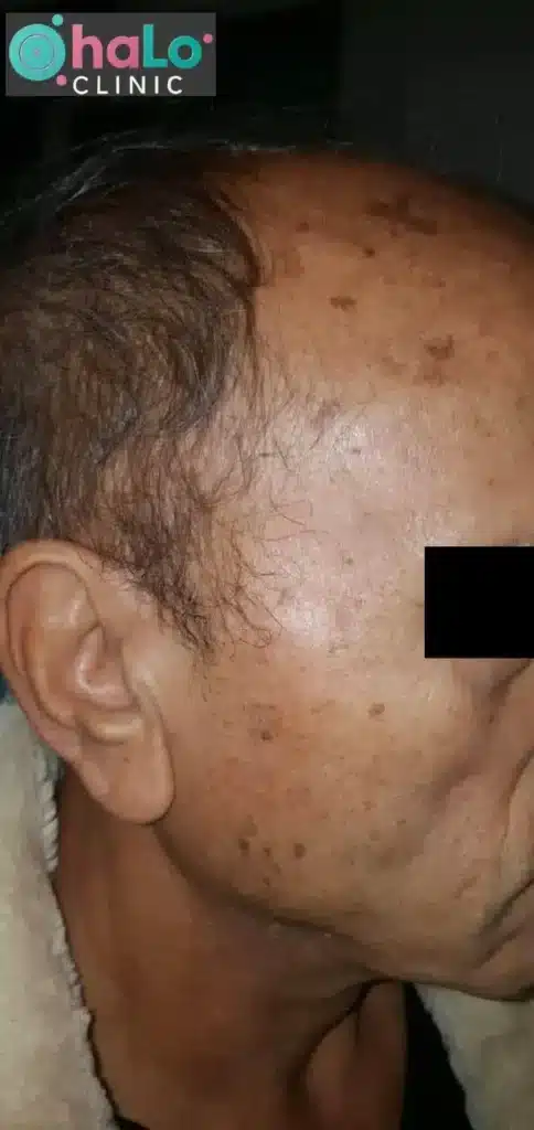 צילום "לפני" טיפול לייזר להסרת נקודות חן ונגעי עור בפנים במרפאת Halo Clinic