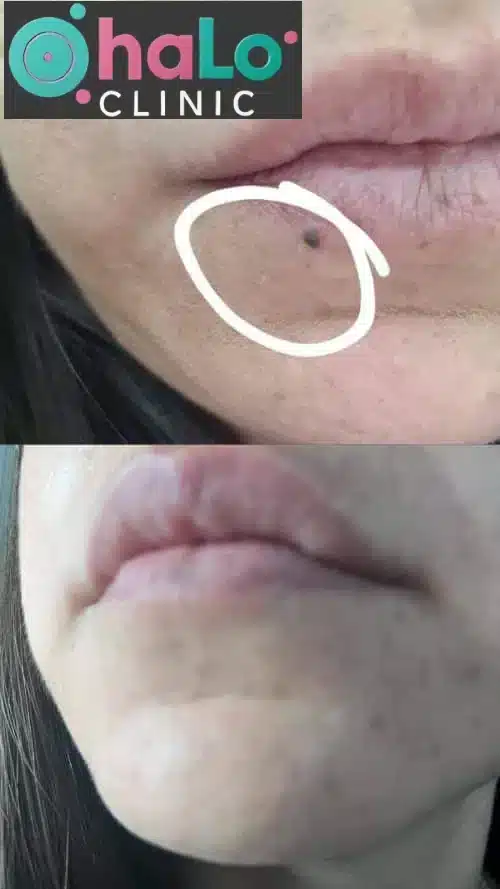 לפני ואחרי הסרת נקודת חן בשפתיים בלייזר – Halo Clinic, תוצאה מדויקת וללא צלקות