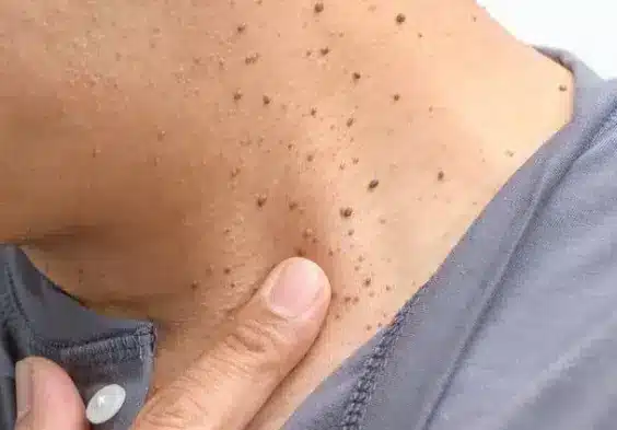 סרחי עור מרובים בצוואר לפני טיפול הסרה בלייזר – Halo Clinic