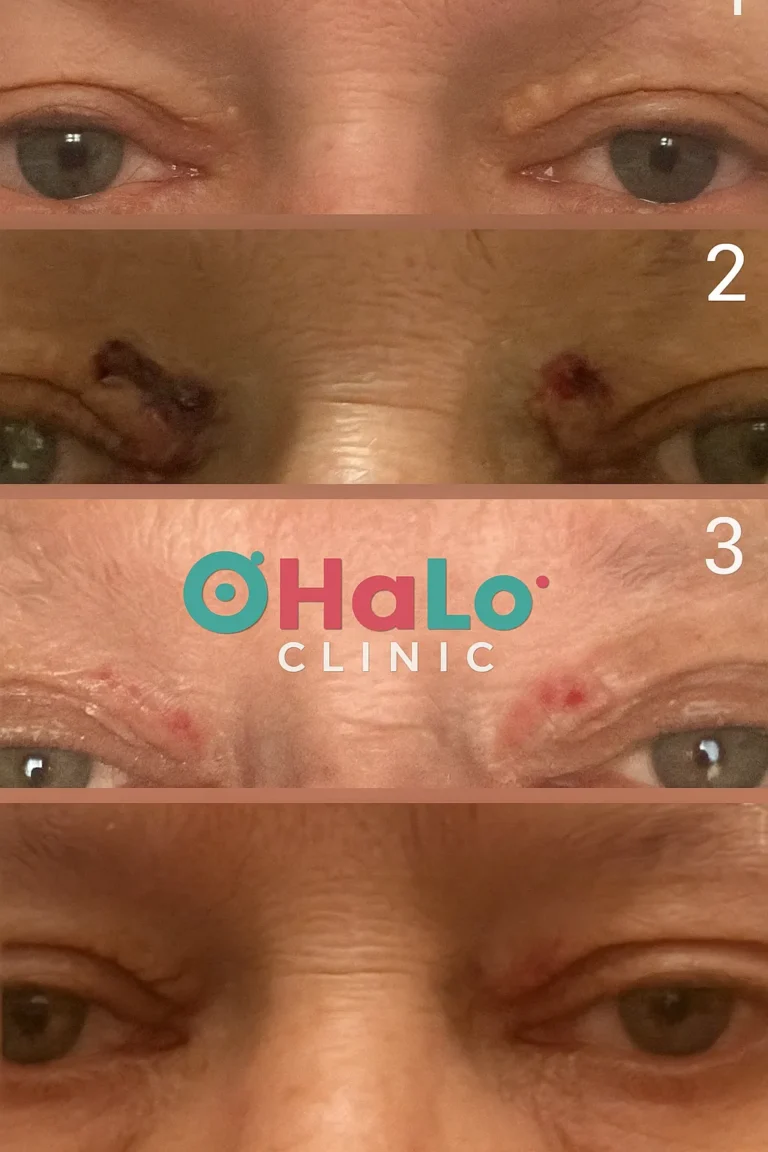 תהליך הסרת קסנטלזמה בעפעפיים – לפני ואחרי, Halo Clinic