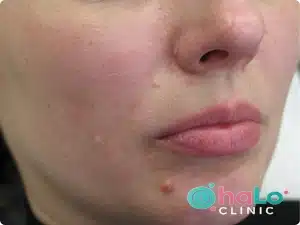 הסרת שומות בפנים עם לוגו Halo Clinic