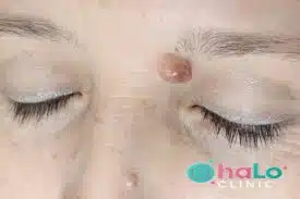 הסרת שומה בפנים עם לוגו הלו קליניק