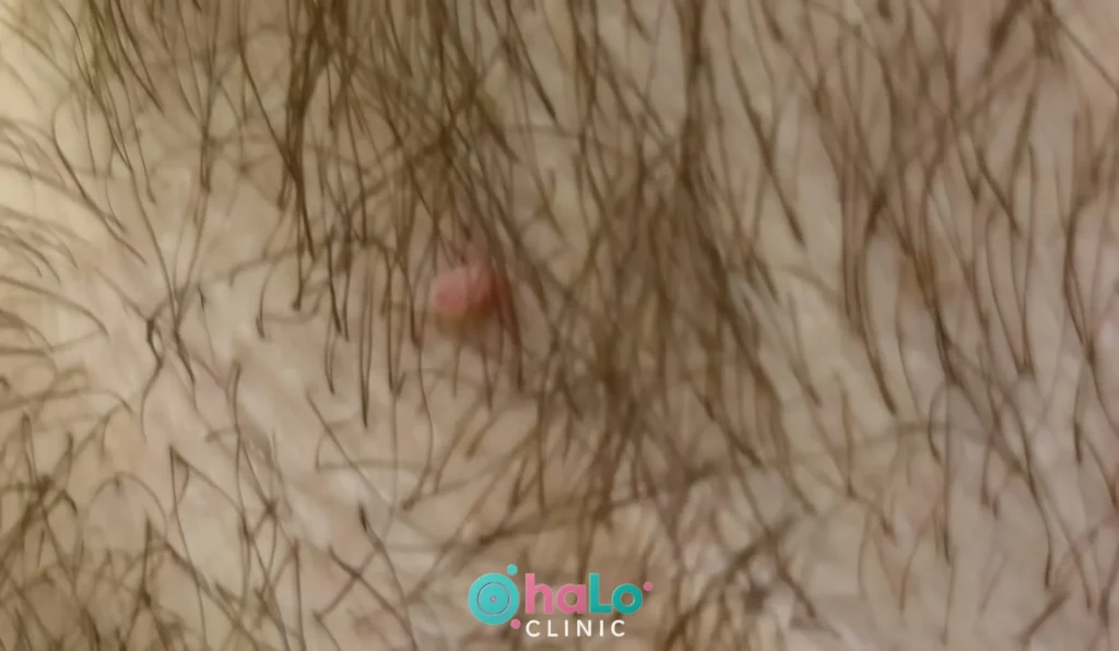 סרח עור בבית השחי לפני טיפול – Halo Clinic להסרת סרחי עור בלייזר