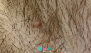 סרח עור בבית השחי לפני טיפול – Halo Clinic להסרת סרחי עור בלייזר