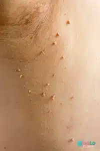 צילום קליני של סרחי עור לפני טיפול הסרה בלייזר – מידע על אבחון והסרה בטוחה