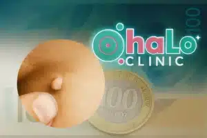 מחיר הסרת סרחי עור בישראל – הליך בלייזר ב־Halo Clinic