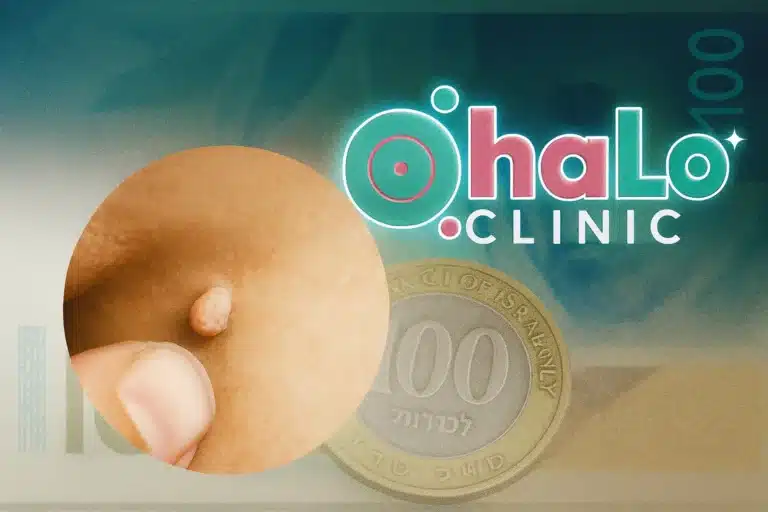 מחיר הסרת סרחי עור בישראל – הליך בלייזר ב־Halo Clinic
