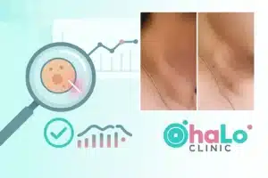 תמונות לפני ואחרי של הסרת סרחי עור בצוואר בטיפול לייזר עדין ב־Halo Clinic, כולל החלמה ושיפור במרקם העור