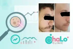 לפני ואחרי הסרת נקודות חן בלייזר בפנים – מקרי בוחן ב-Halo Clinic