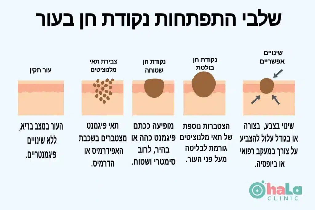 אינפוגרפיקה של שלבי התפתחות נקודת חן בעור, החל מעור תקין ועד לשינויים אפשריים, כולל נקודה שטוחה ובולטת.