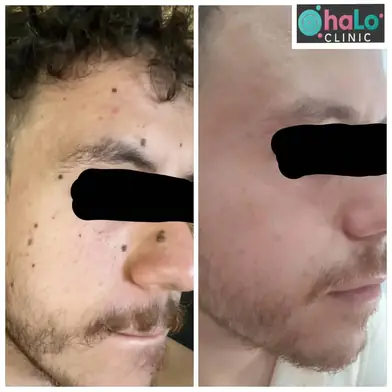 לפני ואחרי טיפול להסרת נקודות חן בלייזר – מראה עור נקי וללא צלקות