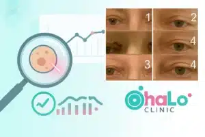 שלבי טיפול בלייזר להסרת קסנטלזמה מהעפעפיים – לפני, אחרי ותהליך ההחלמה ב־Halo Clinic