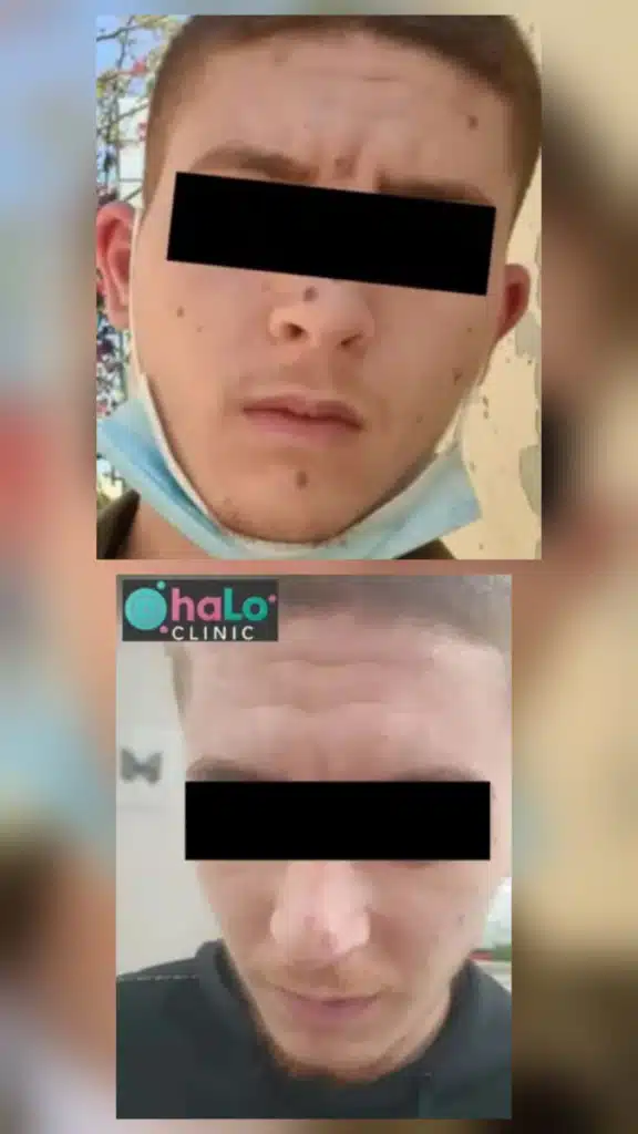 לפני ואחרי טיפול בלייזר להורדת נקודות חן ושומות בפנים – תוצאה חלקה ואסתטית ב-Halo Clinic